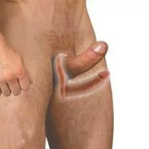 Anel Companheiro com Prótese Auxiliar Maciço 12,4 x 3 cm - AC002